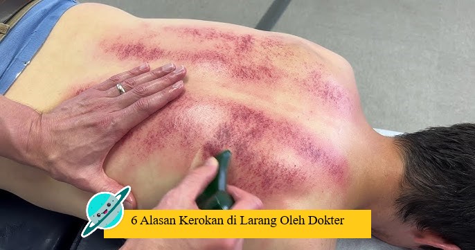 6 Alasan Kerokan di Larang Oleh Dokter